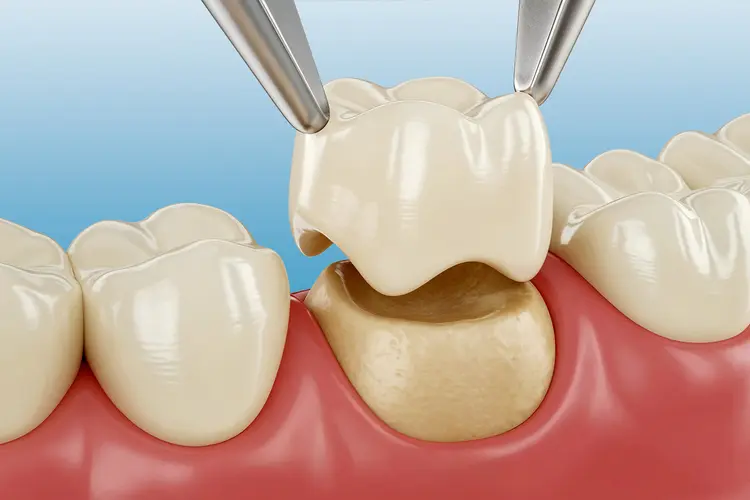 CEREC Crowns: Same-Day Solutions That Save You Time and Money